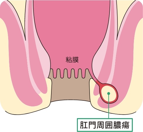 肛門周囲膿瘍
