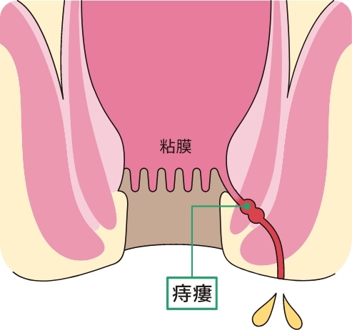 痔瘻