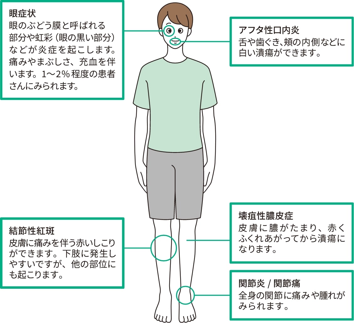 腸管外合併症には、眼症状、アフタ性口内炎、壊疽性膿皮症、結節性紅斑、関節炎などがあります。