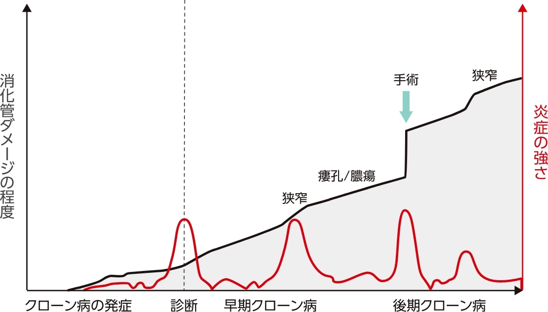 腸管外合併症には、眼症状、アフタ性口内炎、壊疽性膿皮症、結節性紅斑、関節炎などがあります。